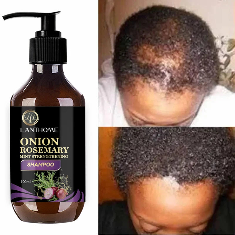 Rosemary onion hair growth shampoo bottle with before and after hair regrowth results on scalp