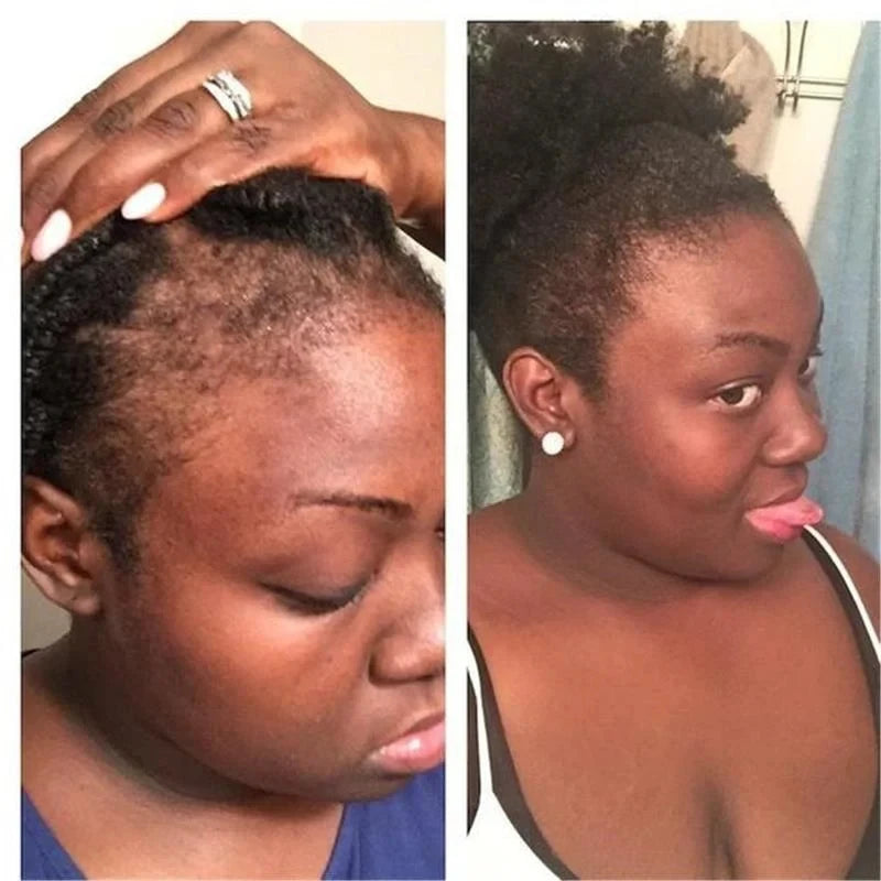 Before and after photos showing significant hair growth using rosemary onion hair growth shampoo